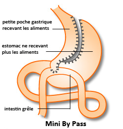 Mini-ByPass Gastrique Mini-ByPass Gastrique Tunisie