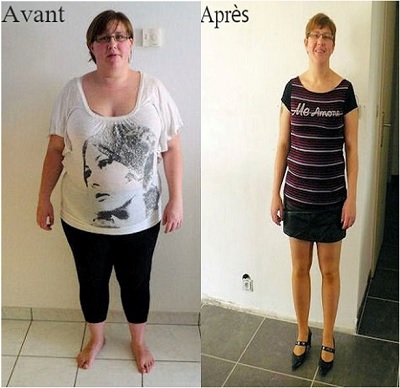 Anneau gastrique Tunisie - Gastroplastie - Prix pose Anneau gastrique Tunisie - Gastroplastie - Prix pose