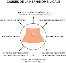 hernie ombilicale