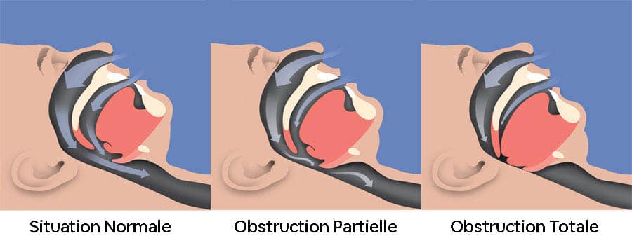 apnee sommeil reflux gastrique