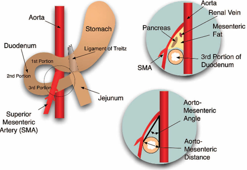 dilatation estomac apres sleeve