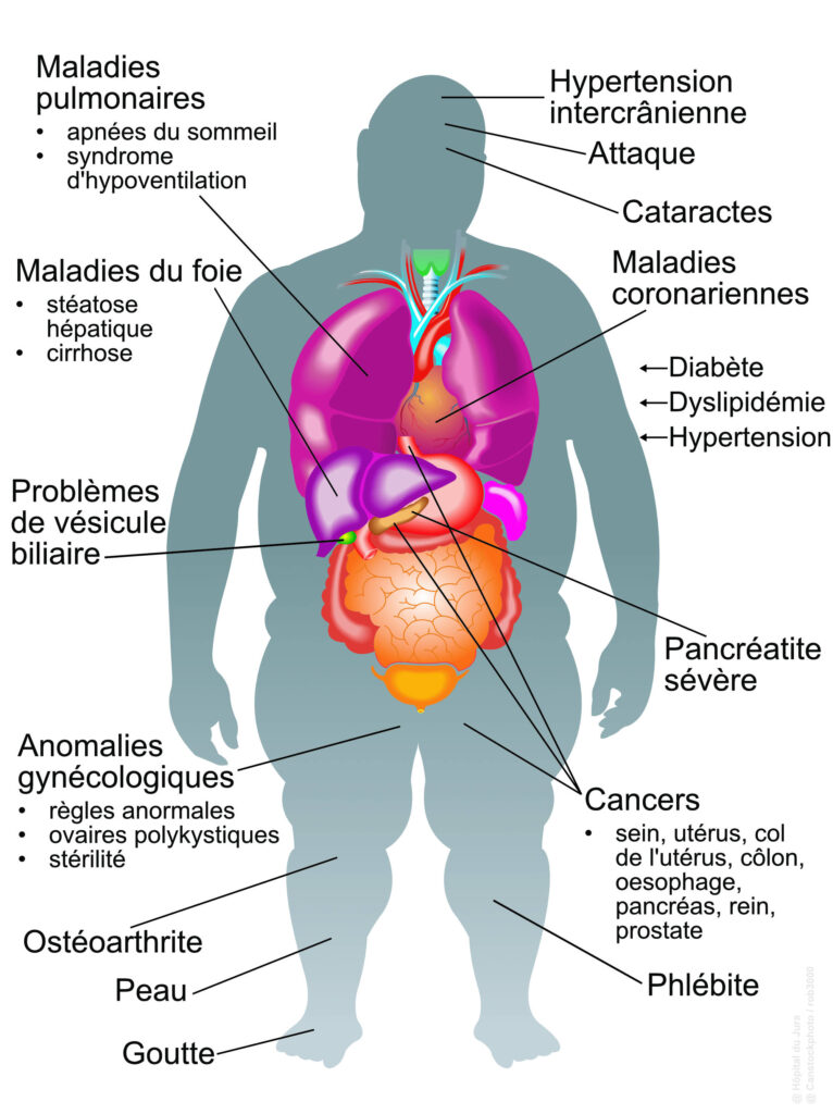 complication pulmonaire obesite