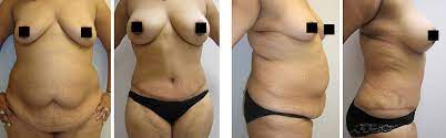 abdominoplastie post obesite