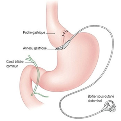 anneau gastrique vomissement