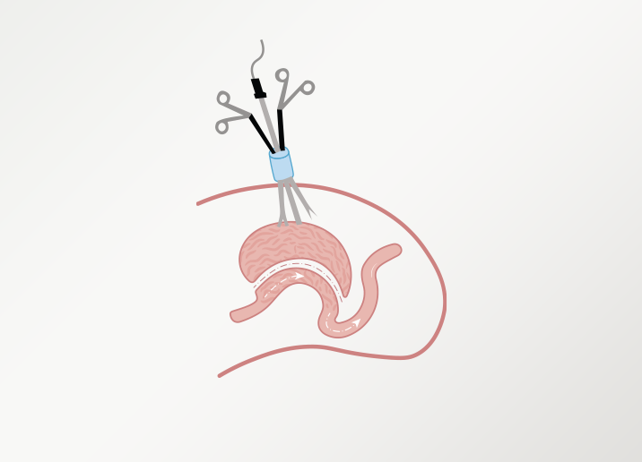 chirurgie laparoscopique à incision unique
