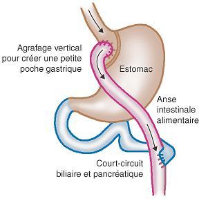 prix bypass gastrique izmir